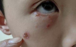 新生儿眼睛周围长水泡是正常现象还是疾病信号？需警惕哪些潜在风险？