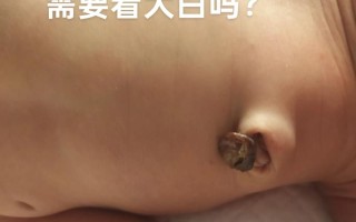 新生儿肚脐50天未脱落，是正常现象还是异常信号？需如何处理？