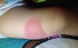 新生儿腿上有个大疙瘩