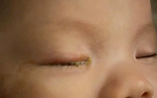 新生儿一只眼睛老有眼屎是正常现象还是生病信号？该怎么处理？