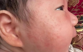 新生儿奶粉上火的症状