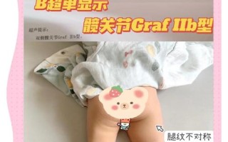 新生儿髋关节发育不良有哪些症状？