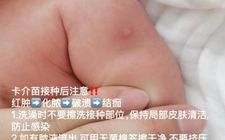 新生儿打卡介苗后出现脓包正常吗？
