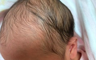 新生儿头颅血肿到底能不能热敷？这样做会不会加重风险？