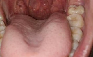 儿童喉咙滤泡增生图片是疾病表现吗？需要治疗吗？