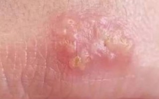 怀孕期间疱疹反复发作，会对胎儿造成哪些不良影响？