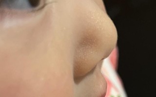 新生儿鼻子白点点是啥？