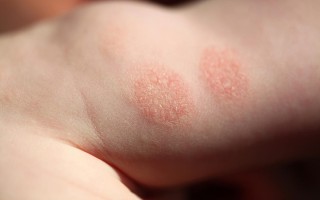 儿童湿疹症状图片 图