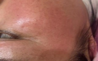 怀孕期间皮肤出现红血丝，是激素变化还是皮肤屏障受损了？