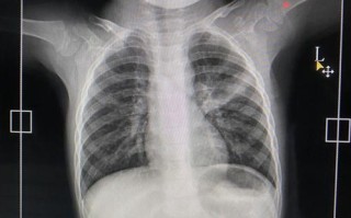 新生儿两肺纹理稍模糊