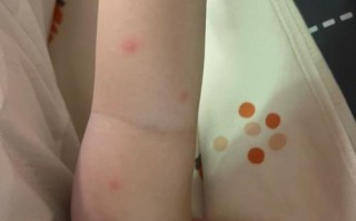 新生儿被蚊子咬红点怎么办？图片需警惕什么？