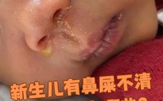 新生儿鼻子老有鼻屎是正常现象吗？该如何正确处理？