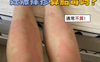 怀孕期间皮肤过敏图片