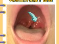 儿童扁桃体肿大必须手术吗？非手术干预如何科学选择？