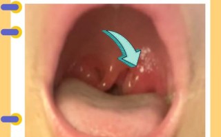 儿童扁桃体肿大必须手术吗？非手术干预如何科学选择？