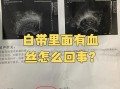 孕期白带有血是危险信号吗？需警惕哪些异常情况？