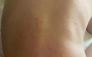 孩子背上突然冒出很多小疙瘩，是过敏了还是皮肤出问题了？