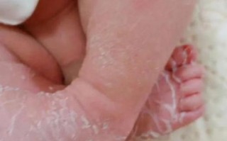 新生儿大腿根部蜕皮正常吗？需要特殊护理还是就医？