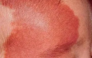 新生儿红色胎记症状有哪些？