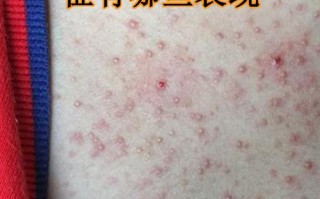 儿童免疫缺陷病有哪些症状？