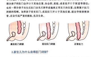 新生儿肛门闭锁能治好吗？治疗方式有哪些？术后护理要注意什么？