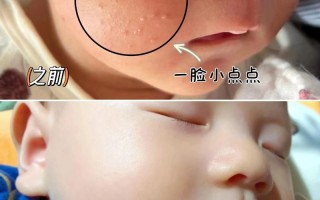 新生儿脸上长小粉刺是什么原因？需要处理吗？会影响皮肤健康吗？