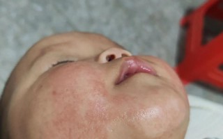 新生儿脸干脱皮，咋办？
