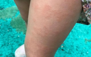 儿童特应性皮炎能治好吗