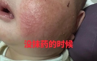 儿童脸上密密麻麻小疙瘩是啥原因？