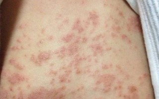 新生儿湿疹症状图片有哪些典型表现？如何辨别不同严重程度的湿疹？