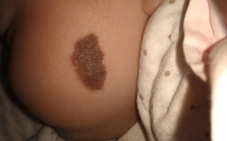 新生儿咖啡色胎记图片大全，常见形态、分布位置与健康风险解析？