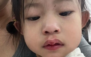 3岁乳门牙磕断，紧急处理要这样做吗？