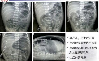新生儿急性坏死性小肠炎有何致命风险？