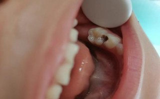 儿童笑气补牙是睡着吗