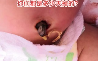 新生儿15天脐带出血是正常现象还是异常情况？需要立即就医处理吗？