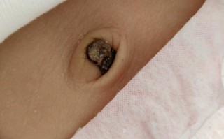 新生儿脐带感染会有哪些异常表现？家长该如何早期识别与处理？