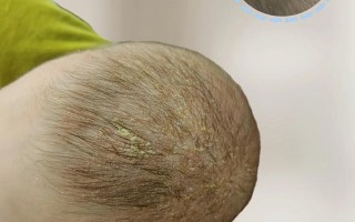 新生儿头上长湿疹，家长该如何正确护理与用药？