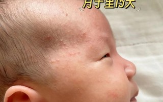 新生儿脸上小白点多久能自行消退？