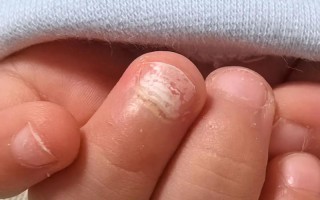 儿童指甲白斑是缺钙还是生病了？