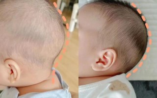 新生儿头后部骨头突出是正常现象还是异常表现？需要警惕哪些疾病风险？