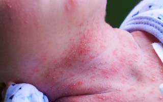 新生儿皮肤红得像小苹果，到底正常还是生病信号？