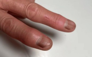 孕期指甲变黑是身体异常信号吗？需要警惕哪些健康问题？