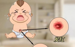 新生儿为什么会有脐炎