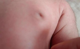 20天新生儿乳房肿大是正常现象还是需要警惕的健康信号？