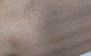 新生儿皮质增生症有哪些典型症状？如何早期识别与干预？