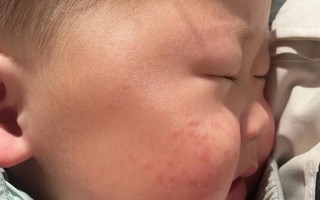 新生儿宝宝脸上长湿疹怎么办？日常护理和用药要注意什么？