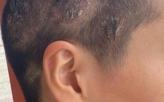 儿童脂溢性皮炎能根治吗？