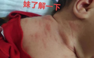 新生儿毒性红斑会痒吗？需要治疗吗？家长该怎么护理？