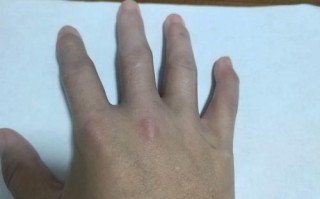 未分化结缔组织病孕期如何管理才能保障母婴安全？