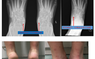 儿童副舟骨突出需要治疗吗？会影响脚部发育吗？